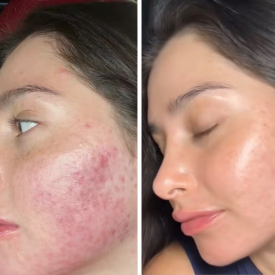Bőr a LumenLuxe LED arcmaszk használata előtt és után – Natalia S.