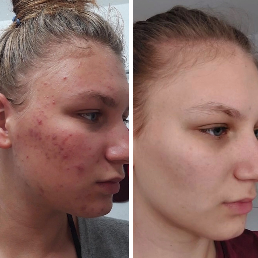 Bőr a LumenLuxe LED arcmaszk használata előtt és után – Monika
